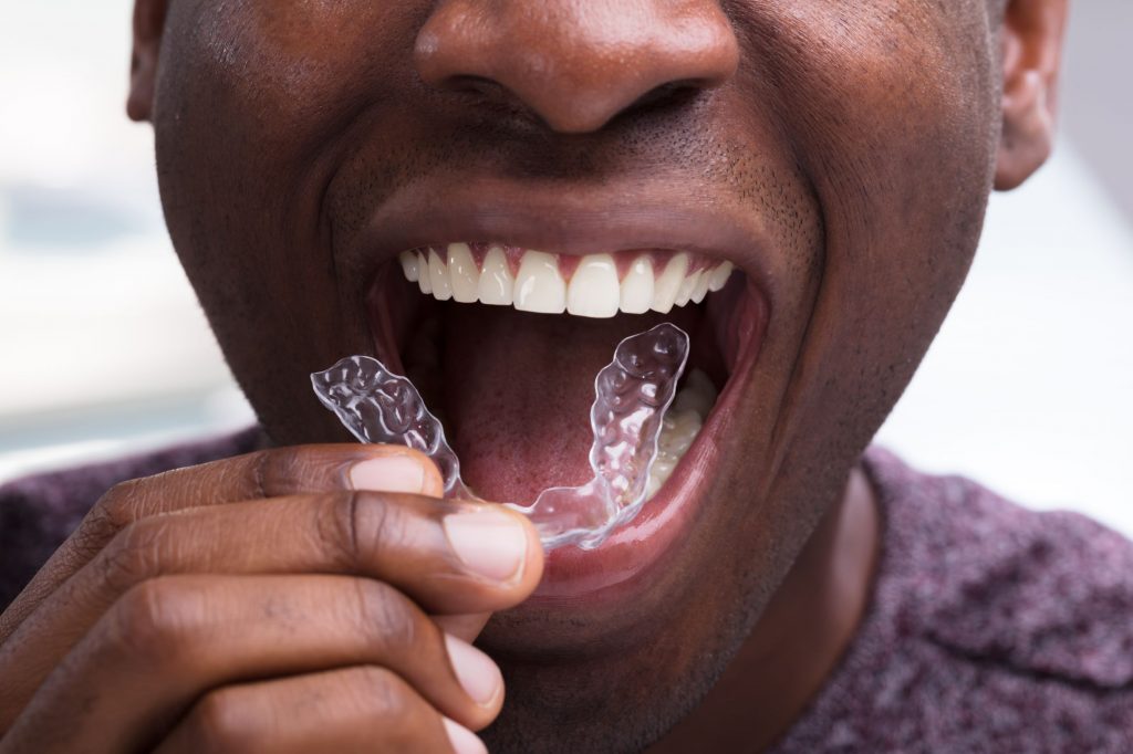 How Much Does Invisalign Cost? Learn More at Kare Orthodontics